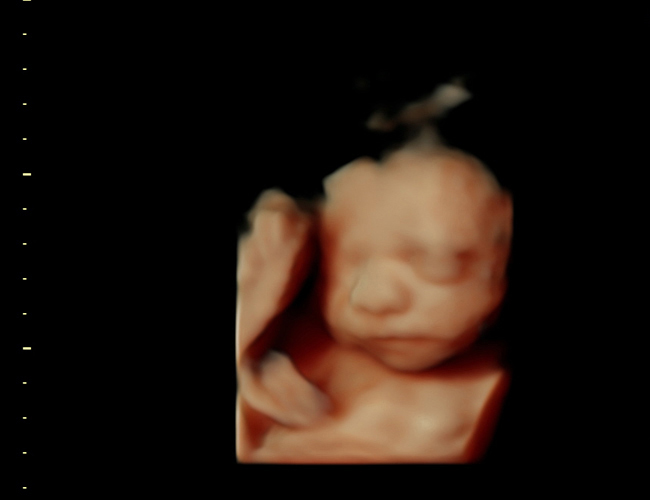 3D ultrasound image at 25 weeks